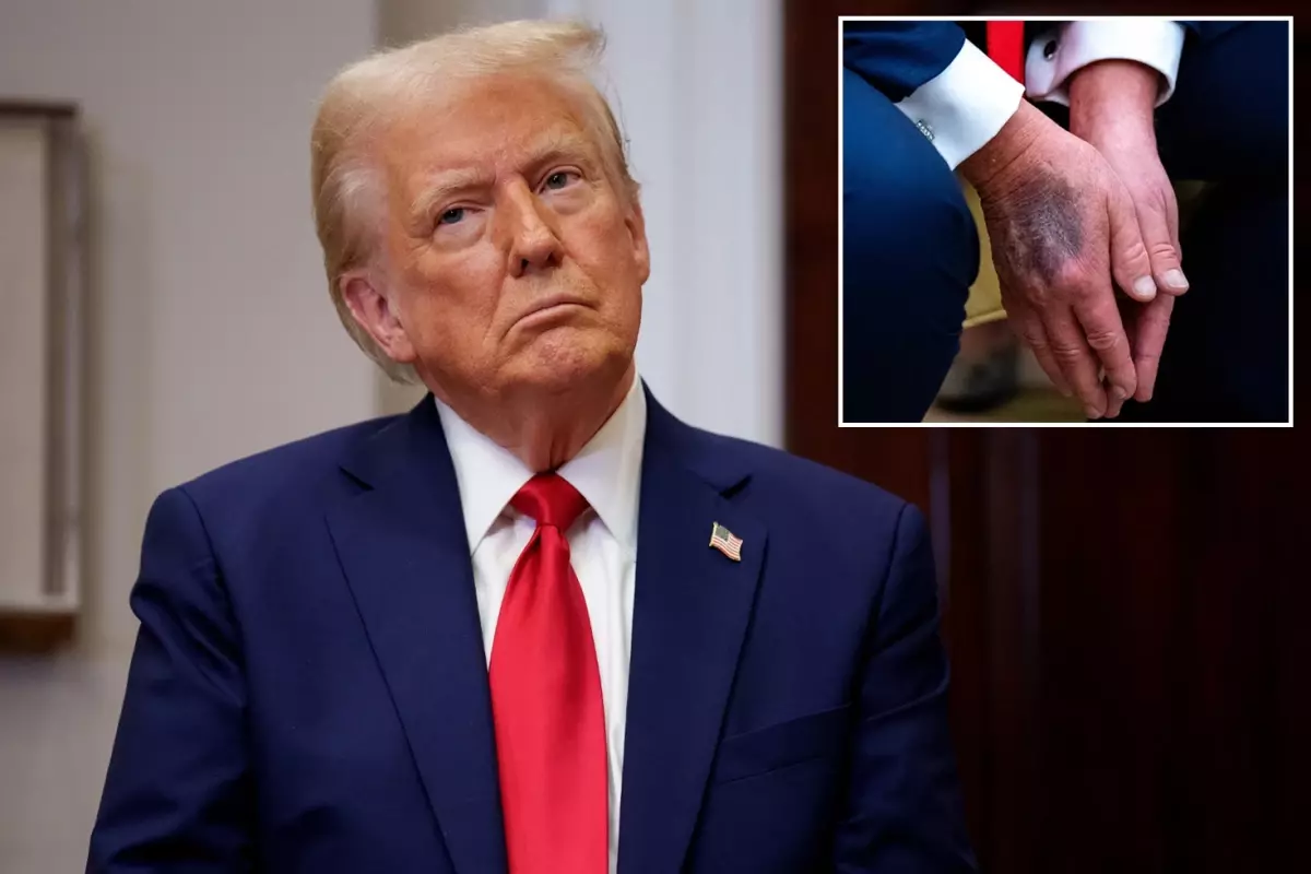 Trump, Elindeki Morlukların Aspirin Kullanımından Kaynaklandığını Açıklıyor