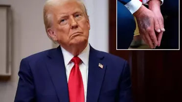 Trump, Elindeki Morlukların Aspirin Kullanımından Kaynaklandığını Açıklıyor