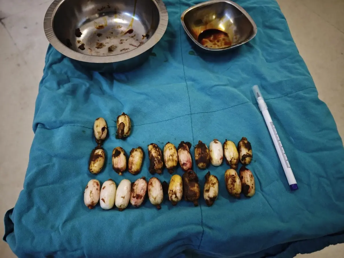 Eskişehir'de Şüpheli S.A.'nın Midesinden 44 Uyuşturucu Kapsülü Çıkarıldı