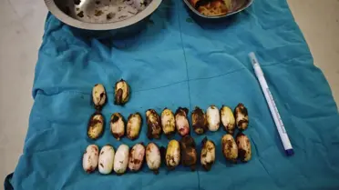 Mideden çıkarılan uyuşturucu kapsüller