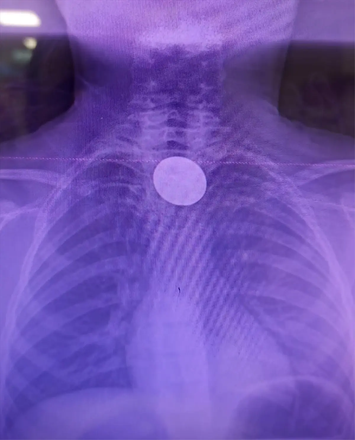 Siirt’te 8 Yaşındaki Çocuğun Boğazına Takılan Madeni Para Acil Müdahale ile Çıkarıldı