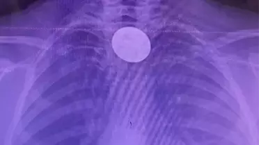 Acil serviste madeni para çıkarma işlemi