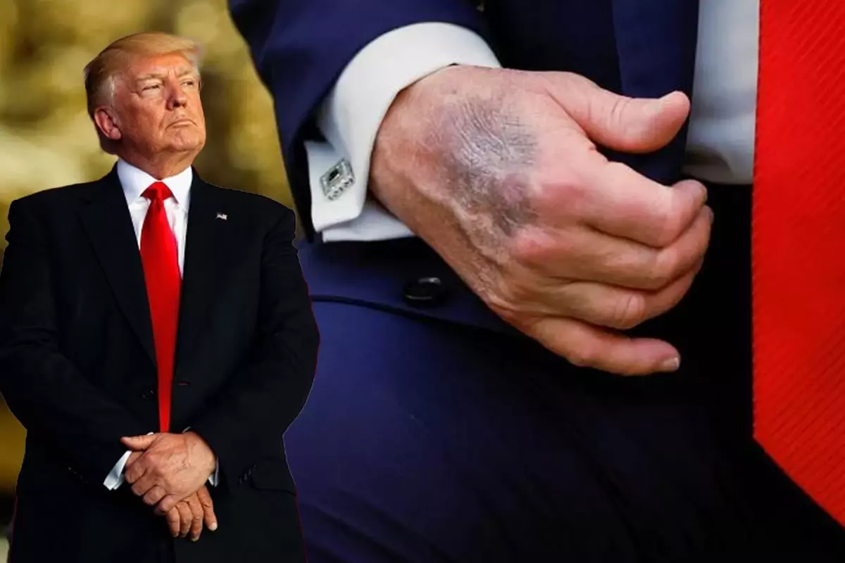 Trump, Morarmış Elinin Nedeni Olarak Masaya Çarpmasını ve Aspirin Kullanımını Açıklıyor