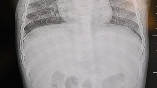 Kahramanmaraş'ta 1 Yaşındaki Bebeğin Sırtından Çıkarılan 2 cm'lik Zımba Teli