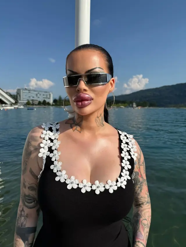 Dudak dolgusu öncesi ve sonrası